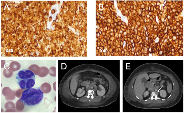 CD3 (A) and CD4 (B) cells immunostained with diaminobenzidine and horseradish peroxidase in lymph node biopsy sample from patient 2 (Aus-GM).  Original magnification ×40. C) Peripheral blood cells smear from adult T-lymphocytic leukemia patient 1 (Aus-NR). Tumor cells exhibiting multilobulated nuclei (or flower cells), which are mature activated CD4+ T-lymphocytes. D) Contrast-enhanced computed tomographic image of abdomen of patient 1, revealing para-aortic lymphadenopathy. E) Contrast-enhanced