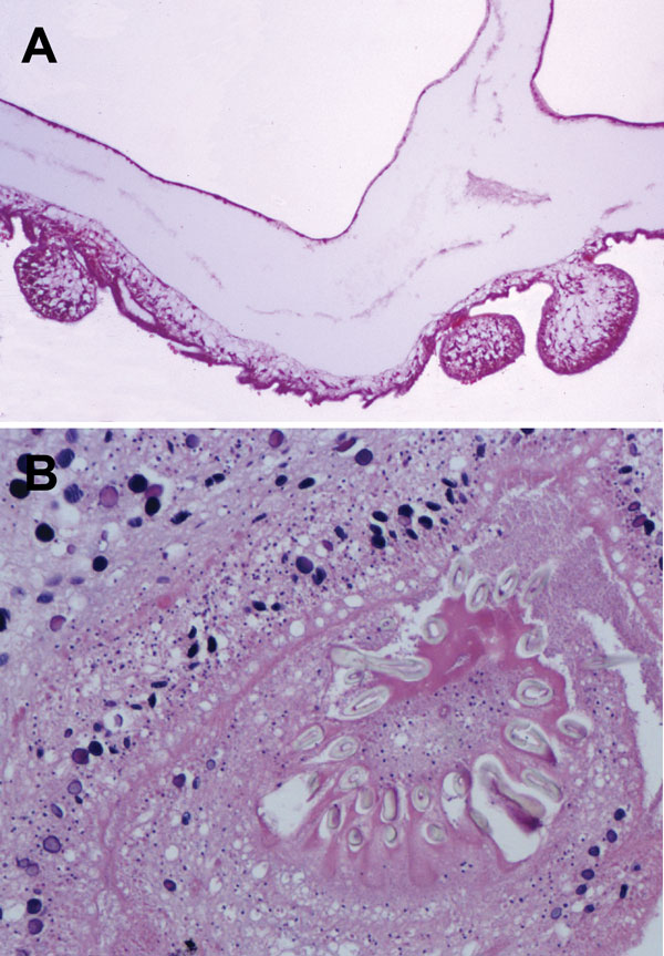 Histologic section through Taenia crassiceps tapeworm larvae removed from the cerebellum of a 51-year-old woman, Germany. A) Section through parasite body showing multiple connected bladders (asexual buddings) at the caudal end. Original magnification ×20. B) Transverse section through the parasite’s protoscolex showing numerous hooklets, similar to T. solium tapeworm larvae. Original magnification ×40. Like the Taenia solium tapeworm that causes cysticercosis, and in contrast to different tapew