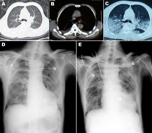 Chest computed tomography (CT) scan and radiograph images of patient (case-patient 1) in a study of 4 persons with early cases of influenza A(H7N9) virus infection, Shanghai, China. Images were taken 1, 5, 7, and 11 days after illness onset. A, B) CT scan images on day 1, showing bilateral pleural effusion but no obvious lesions. C) CT scan image on day 5, showing extensive ground-glass opacity and consolidation. D, E) x-ray images on days 7 and 11, respectively, showing reduced light transmitta