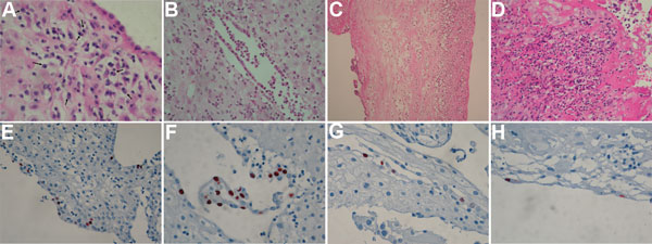 Histopathologic analysis of placentas from women tested for infection with Waddlia chondrophila. A) Patient 140, chronic endometritis with various inflammatory cells in the deciduas, including plasmocytes (arrows) (original magnification x600). B, Patient 183, polymorphonuclear cells (PMN) in a an endometrial gland (original magnification x400). C) Patient 305, chorioamnionitis with PMN extending from the chorion to the amnios (original magnification x200). D) Patient 535, PMN in the subchorial 
