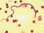Thumbnail of Mansonella perstans nematode in peripheral blood mononuclear cells from Buruli ulcer patient in Ghana. Cells were stained with Giemsa (original magnification ×1,000). M. perstans nematodes can be distinguished from Loa loa and Wuchereria bancrofti nematodes by relative small size, detection in blood samples obtained during the day, and lack of a sheath. 