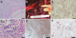 Thumbnail of Images of tissue samples from 2 stranded coastal Indo-Pacific bottlenose dolphins (Tursiops aduncus) from Western Australia, Australia. A) Brain of dolphin 2 showing cerebral hemisphere with focally extensive suppurative and necrotizing encephalitis surrounding an arteriole. There are intramural and perivascular septate branching hyphae. Hematoxylin and eosin stain. Scale bar = 50 μm. B) Lung of dolphin 3 showing a transected lobar surface exhibiting multifocal pyogranulomas (white 