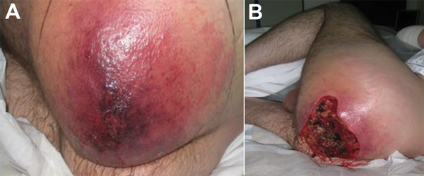 Manifestation of heroin-associated anthrax in patient 1, who injected heroin under the skin of his left buttock 1 week before seeking treatment. Panel A demonstrates severe edema with poorly demarcated erythema. He had debridement within hours of arrival. Panel B demonstrates the extent of debridement required to reach healthy tissue and to reduce the toxin burden; there was copious drainage of fluid and pus as well as bleeding to the area. The tissue between affected and unaffected areas was po