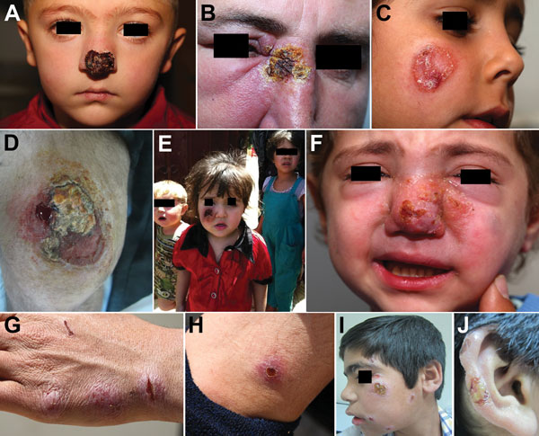 Patterns of leishmaniasis among Syrian refugees in Lebanon, 2012. A,B) Lesions impinging and possibly hindering the function of vital sensory organs, including the nose and eyes. C,D) Lesions &gt;5 cm.E,F) Lesions disfiguring the face. G,H) Special forms of cutaneous leishmaniasis; shown here is a patient with spread and satellite lesions on the hand and arm. I,J) Patient with 15 lesions.