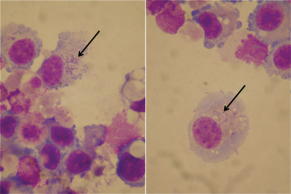Orientia tsutsugamushi (arrows) in culture of bronchoalveolar lavage fluid from a patient with acute respiratory distress syndrome (Diff-Quick stain, VWR International, France). Original magnification ×100.