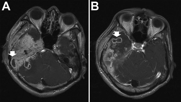 Brain computed tomography scan images for a patient with central nervous system infection caused by Mycobacterium abscessus subsp. bolletii. Arrows indicate abnormal nodular pachymeningeal thickening and leptomeningeal and intraparenchymal extension with multiple rim-enhancing lesions in the right cerebellum (A) and right temporal lobe (B), indicating cerebral abscesses.