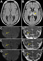 Thumbnail of Magnetic resonance imaging (MRI) results for a US patient with variant Creutzfeldt-Jakob disease. A) T1 sequence. B) T2 FLAIR sequence showing the “pulvinar” or “hockey stick” sign (arrowhead). Initial Diffusion Weighted Imaging (DWI) (C) and Apparent Diffusion Coefficient (ADC) (D) images show subtle restricted diffusion in right primary motor cortex; subsequent MRIs show increasing hyperintensity on DWI (E,G) and further attenuation on ADC (F,H), consistent with the “cortical ribb