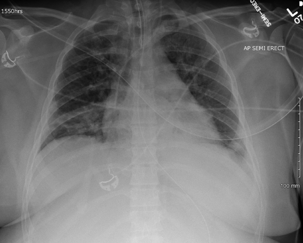 Chest radiograph obtained (with portable machine) of semirecumbent adult patient with enterovirus D68–associated acute respiratory distress syndrome on hospital day 3.