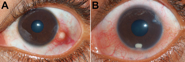 Clinical photographs of patients’ eyes in study of ocular granulomas in children, South India. A) Left eye of a 14-year-old boy with a distinct subconjunctival granuloma; B) left eye of a 7-year-old boy with distinct grayish-white granuloma in the eye’s anterior chamber.