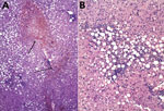 Thumbnail of Histopathologic appearance of liver biopsy sample from woman with fatal human monocytic ehrlichiosis, Mexico, 2013. A) Necrotic hepatic lesions in a patchy distribution (arrows). Hematoxylin and eosin (H&amp;E) stain; original magnification ×100. B) Macrovesicular steatosis and inflammatory lymphocytic infiltrate. H&amp;E stain; original magnification ×200. 