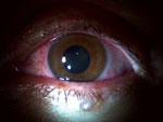 Thumbnail of Slit lamp examination of the left eye of a physician from the United States who contracted Ebola virus disease in Liberia and had eye inflammation develop during convalescence. Image shows diffuse blood vessel injection, mild corneal edema with fine inferior keratic precipitates, fibrin reaction, and leukocytes in the anterior chamber without hypopyon. Used with permission of the patient.