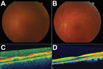 Thumbnail of Color fundus and optical coherence tomography (OCT) images during active uveitis and after resolution for a physician from the United States who contracted Ebola virus disease in Liberia and had eye inflammation develop during convalescence. A) Color fundus image of the left eye showing a hazy view to the posterior pole during active uveitis (standardization of uveitis nomenclature classification grade 2–3). B) Color fundus image of the left eye showing a clear view to the posterior