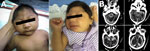 Thumbnail of Microcephaly, Pernambuco State, Brazil, 2015. A) Two newborns in whom microcephaly was diagnosed during the epidemic. B) Brain computed tomography scan of a 43-day-old infant showing cerebellar hypoplasia, parenchymal calcifications, ventriculomegaly, and malformation of cortical development compatible with lissencephaly.