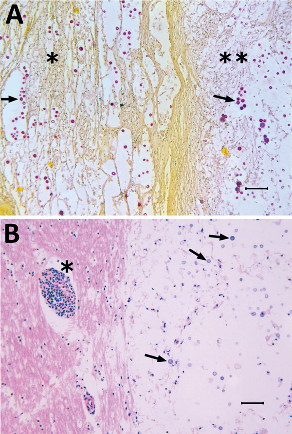 Tissue from white-tailed deer (Odocoileus virginianus), showing microscopic lesions caused by a unique Cryptococcus gattii VGIIb variant strain most similar to that of the VGIIb genotype; etiology was confirmed by molecular sequencing. A) Photomicrograph of lung lesions with intralesional C. gattii (arrows indicate examples of individual yeast) in a mass (**) and in adjacent compressed alveolar spaces (*). Mucicarmine stain; original magnification ×10. B) Photomicrograph of a brainstem lesion wi
