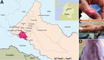 Thumbnail of Location of 6 patients with poxvirus infections and photographs of lesions from 3 patients, Colombia, 2014. A) The municipalities of Valparaíso (residence of patients 1–5) and Solita (residence of patient 6) are 36 km apart in the southwestern region of the department of Caquetá. Yellow, white, and blue stars denote locations of patients 2, 3, and 4, respectively. Inset shows location of Caquetá in Colombia. Map source: Departamento Administrativo Nacional de Estadística (http://geo
