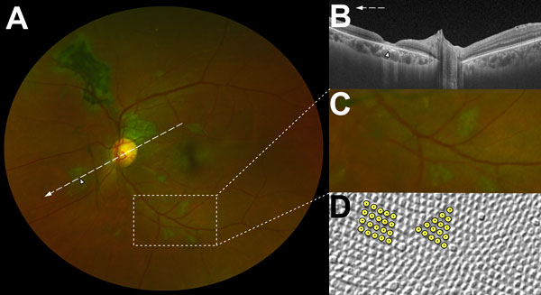 Characteristic features of lesions observed in a case–control study of ocular signs in Ebola virus disease survivors, Sierra Leone, 2016. A) Composite scanning laser ophthalmoscope retinal image, left eye. Arrow indicates direction of the optical coherence tomography scan. B) Optical coherence tomography. White, long, dashed line indicates cross-sectional plane; white arrowhead indicates Ebola lesion limited to the retinal layers with an intact retinal pigment epithelium. Magnified 1.5× from ori