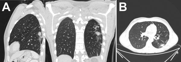 Computed tomography of the lungs in patient with invasive fungal disease caused by Inonotus spp., Madrid, Spain. Images show pulmonary nodule with halo sign in the left superior lobe, with peripheral distribution. 