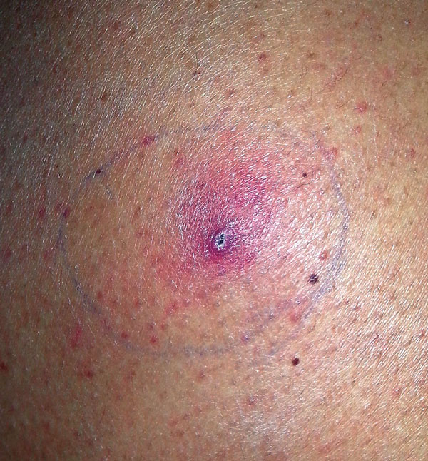 Skin lesion at biopsy site 4 weeks after the biopsy in patient with invasive fungal disease caused by Inonotus spp., Madrid, Spain. 