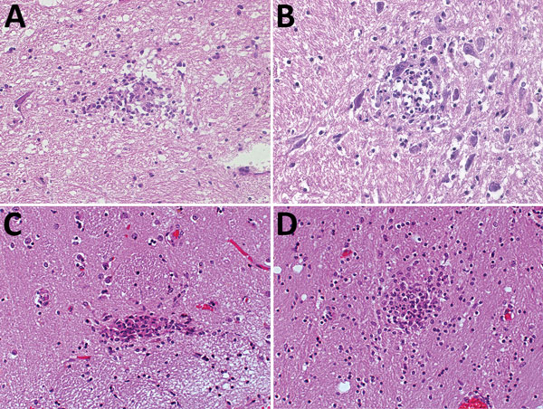 Hematoxylin and eosin staining of typical typhus nodules in brain of typhus patients during World War II, Hamburg, Germany, 1940–1944. Most nodules were found in the pons and medulla oblongata. A) Loose nodule. B) Spongy nodule amid large neuronal cells. C) Compact typhus nodule along longitudinal blood vessel. Note hyperemia of other blood vessels nearby. D) Another compact nodule with hyperemic blood vessels nearby. Original magnifications ×40.