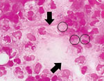 Thumbnail of Gram staining of pus obtained from a patient with rat-bite fever. Circles indicate pyrophosphate calcium crystals. Arrows indicate chain-shaped gram-negative bacilli. Original magnification ×1,000.
