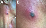 Thumbnail of Eschar on right anterior neck of patient with dual genotype Orientia tsutsugamushi infection, Vietnam. A) Eschar location; B) enlarged view.