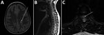Thumbnail of Magnetic resonance images (MRIs) on day 10 of illness in a 10-year-old girl with transverse myelitis and Guillain-Barré syndrome associated with cat-scratch disease, Houston, Texas, USA, 2011. A) Brain MRI. Arrow indicates focus of increased T2 signal in the left posterior periventricular and deep white matter. B) Sagittal spine MRI. Arrow indicates long segment of increased T2 signal centrally located within the spinal cord. C) Axial thoracic spine MRI. Arrow indicates increased ce