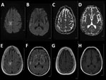 Thumbnail of Magnetic resonance imaging for a 54-year-old man with progressive multifocal leukoencephalopathy after treatment with nivolumab, showing typical multifocal lesions: diffusion weighted imaging hyperintensity (A, B) without a decrease in the apparent diffusion coefficient (C, D), corresponding patchy corticosubcortical hyperintensities on fluid-attenuated inversion recovery image (E, F) without enhancement on T1-weighted imaging after administration of gadolinium (G, H).