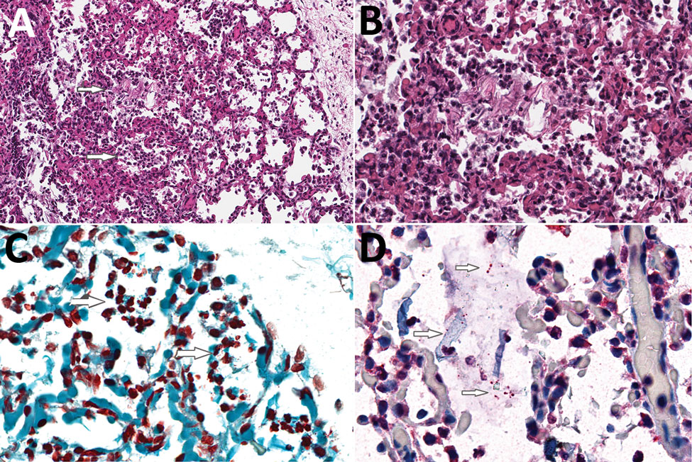 Histologic evidence of amniotic fluid aspiration, bronchopneumonia, and intraalveolar gram-negative coccobacilli in the lung of a stillborn infant, Mozambique. A) Hematoxylin and eosin stain of lung tissue showing acute inflammation within alveoli (bronchopneumonia, upper arrow) and moderate numbers of aspirated squames (lower arrow), consistent with intrauterine fetal distress and associated aspiration of amniotic fluid. Original magnification ×20. B) Higher magnification of panel A tissue show