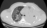 Thumbnail of Chest computed tomography of a patient in France with Panton-Valentine leukocidin–secreting Staphylococcus aureus pneumonia complicating coronavirus disease, showing worsening of bilateral parenchymal damage with complete consolidation of the left lung, cavitary lesions suggestive of multiple abscesses, and appearance of areas of ground-glass opacities in the right lung