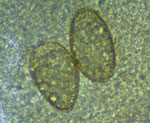 Paragonimus eggs from sputum from a patient in Ecuador. Eggs are yellow, elongated, have a thick shell, and are asymmetric with 1 end slightly flattened. The operculum is clearly visible at the large end and is thickened at the abopercular end. Original magnification ×40, size 80–90 μm × 45–50 μm.