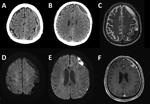 Initial image findings of subdural empyema in a patient with Streptococcus suis infection, Jeju Island, South Korea. A, B) Computed tomography scans. D–F) Magnetic resonance imaging: diffusion weighted (D, E), T2 (C), and enhanced T1 (F). 