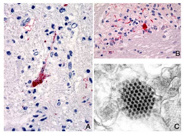 A). Positive immunostaining of EV71 antigens in neuron and neuronal process. Original magnification, X158. B). Positive immunostaining of EV71 antigens in necrotic area. Original magnification, X158. C). An array of picornavirus particles in a neuron (electron micrograph).