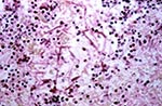 Thumbnail of Biopsy of foot lesion: area of extended dermal necrosis with inflammatory infiltration. In the center, PAS- (periodic acid-Schiff stain) positive septate hyphae branching at an acute angle (x400).