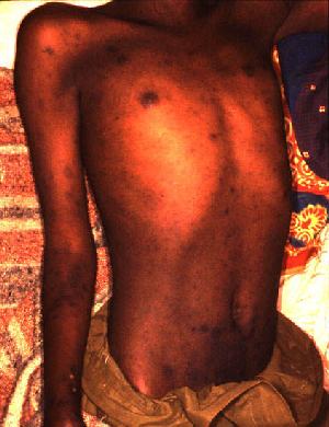 Rash in a man with epidemic typhus in Burundi.