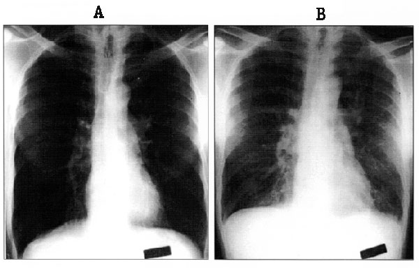 Chest radiographs of patient T/Tx at hospital admission on August 20, 1996 (Panel A), and during a period of increasing respiratory distress on August 22, 1996 (Panel B). Note the diffuse interstitial infiltrate and peribronchial cuffing that developed over that interval.