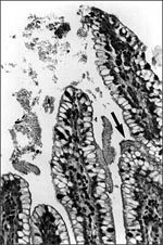 Thumbnail of Biofilm (arrow), containing aggregating bacteria and mucus, adhering to the mucosa of a gnotobiotic piglet fed enteroaggregative E. coli strain 042 and sacrificed after 3 days. This piglet did not contract diarrhea. (Reprinted with permission of James Nataro and Clinical Microbiology Reviews. Clin Microbiol Rev 1998;11:142-201.)