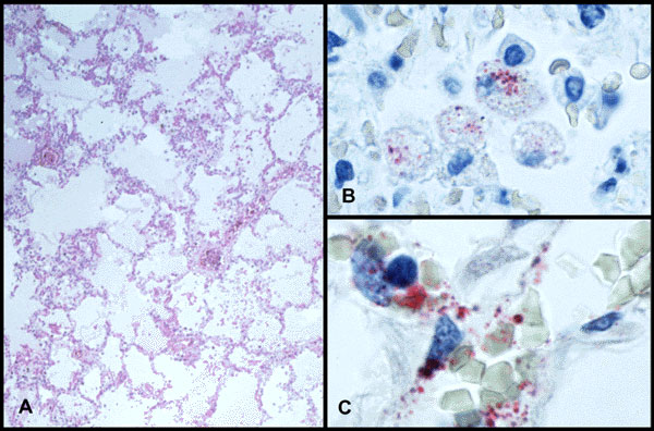 A) Low-power photomicrograph of lung showing interstitial pneumonitis and intraalveolar edema. B) Andes virus antigen–positive intraalveolar macrophages. C) Fine granular immunostaining of hantaviral antigens in endothelial cells of pulmonary microvasculature. (A, Hematoxylin and eosin; B,C, napthol-fast red with hematoxylin counterstain; original magnifications A x 50, B and C x 250.)