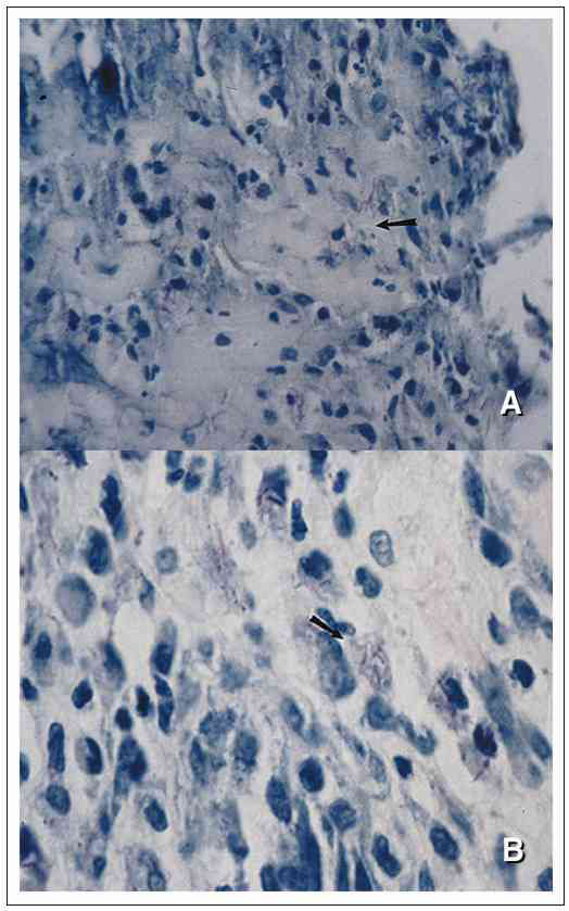 Active disease histopathologic sections of soft tissue stained for acid-fast bacilli from a patient with a Mycobacterium marinum infection. In A, the arrow indicates localized necrosis, and in B, the arrow indicates predominance of intracellular bacilli.  (Slide courtesy of Arthur B. Abt and Leslie Parent, Penn State Geisinger Health System and Pennsylvania State University College of Medicine, Hershey Medical Center, Hershey, Pennsylvania.)