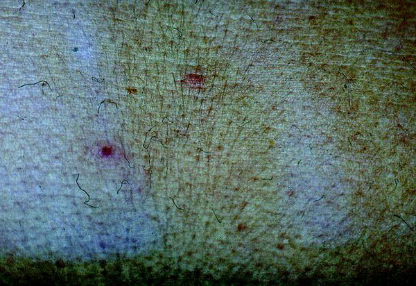 Rose spots-like skin lesion on the trunk (day 4).