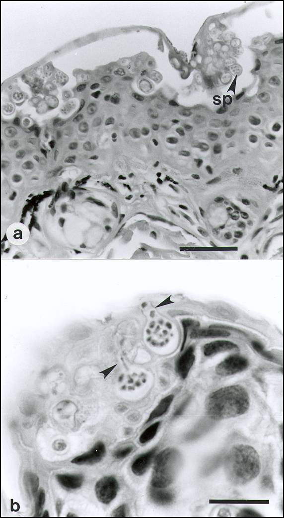 . A: Ventral abdominal skin of Bufo haematiticus from western Panama. The superficial keratinized layer of epidermis (stratum corneum) contains numerous intracellular spherical-to-ovoid sporangia (spore-containing bodies) of Batrachochytrium sp. The mature sporangia (sp, arrows) are 12-20 µm (n = 25) in diameter and have refractile walls 0.5-2.0 µm thick. Most sporangia are empty, having discharged all zoospores, but a few sporangia contain two to nine zoospores. This stratum corneum is markedly