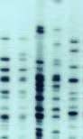 Multidrug-resistant Acinetobacter baumanii