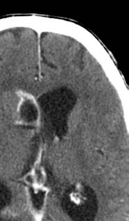 Atypical Infections in Tsunami Survivors