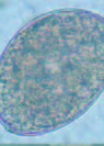 Diphyllobothriasis, Brazil