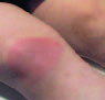 Borrelia spielmanii Erythema Migrans, Hungary