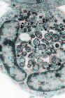 Human Granulocytic Anaplasmosis and Anaplasma phagocytophilum