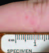 Rabies Postexposure Prophylaxis, New York, 1995–2000