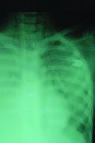 Human Disease from Influenza A (H5N1), Thailand, 2004