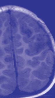 Human Metapneumovirus RNA in Encephalitis Patient