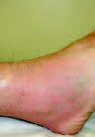 Ross River Virus Disease Reemergence, Fiji, 2003–2004