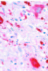 Virology, Pathology, and Clinical Manifestations of West Nile Virus Disease